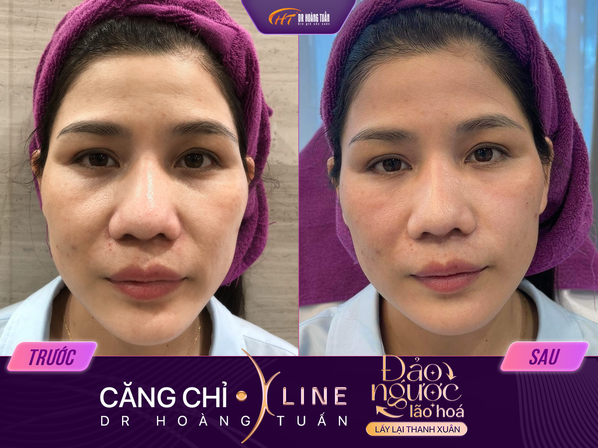 Kết quả căng chỉ xline